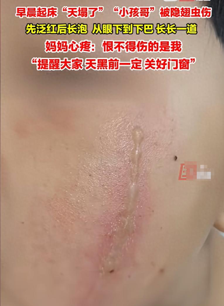 天气渐热未装纱窗，常德一娃脸被隐翅虫灼伤，家长需警惕